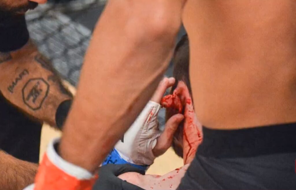 terrible lesión en MMA